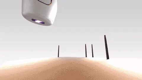IPL Laser Hair Removal Portable / جهاز إزالة الشعر بالليزر القابل للحمل